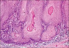 Keratin pearls also are found in some instances of basal cell Uncommon Location Of Verrucous Carcinoma
