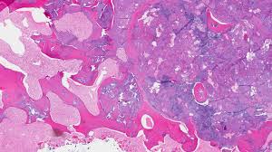 Image result for Chondrosarcoma