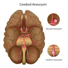 Brain Aneurysm Headway