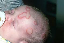 Biasanya, hal ini terjadi karena kulit bayi tidak cocok dengan bahan popok yang sebenarnya, ruam kulit pada bayi ini bukan diakibatkan oleh asi atau susu formula. 13 Cara Hilangkan Ruam Bayi Panduan Lengkap 2019 Ethissa