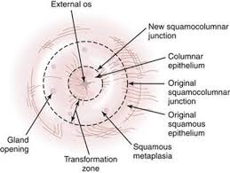 One of the fears of hpv infection is that it can turn into cervical cancer. Cervical Dysplasia And Cancer Hacker Moore S Essentials Of Obstetrics And Gynecology With Student Consult Online Access 5th Ed