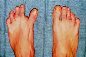 Image result for Hallux Varus