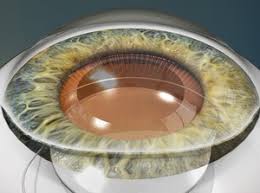 Image result for Cataract Extraction