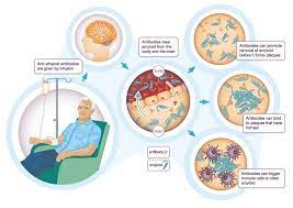 Aducanumab (biib037) is an investigational therapy from biogen for treating alzheimer's disease. Behind The Headlines Is A New Alzheimer S Treatment In Sight Alzheimer S Research Uk