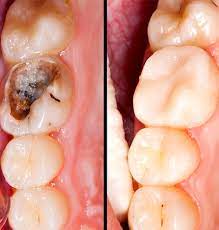 Ask your dentist which tips are best for you. How To Tell If You Have A Cavity What Does A Cavity Look Like