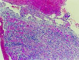 • electron microscopic examination is only rarely contributory as with the characteristic intranuclear inclusion bodies that may be seen in. Enteroviral Infection Causing Fatal Myocarditis And Subclinical Myopathy Heart