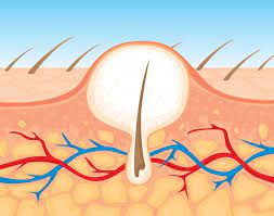How To Treat And Prevent Saddle Sores – Triathlete