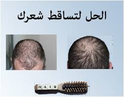 اذا كنت تعاني من تساقط الشعر و هي مشكلة شائعة لدى الرجال فأننا نقدم لك في هذا المقال اهم طرق علاج تساقط الشعر للرجال و التي تسهم في تخفيف أو علاج المشكلة