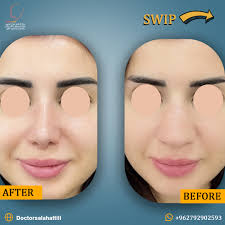 مركز الدكتور صلاح العتيلي لجراحة وتجميل الأنف والأذن الحنجرة‎ added a new  photo — in Jordon...