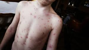 Impfung Mumps Masern Roteln Windpocken Br Wissen