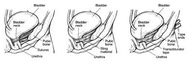Urinary Incontinence In Women Symptoms Causes Treatment
