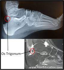 Posterior Ankle Impingement Os Trigonum Syndrome Footeducation
