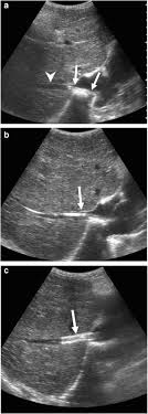 Ultrasonography In Pediatric Budd Chiari Syndrome Springerlink