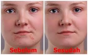 Bintik bintiknya dibersihin cara mengatasi jerawat di kulit kepala ilustrasi seorang dokter menjelaskkan kepada pasiennya. Cara Mudah Menghilangkan Jerawat Dengan Adobe Photoshop Cs3 Tutorilio