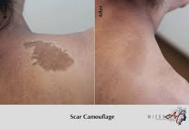It completely depends on the area, so consult your tattooist before you begin. Scar Treatment By Microart Semi Permanent Scar Camouflage
