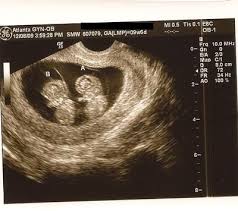 Identical Twins Vs Fraternal Twins Twins Ultrasound Fraternal Twins Identical Twins