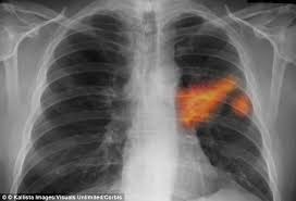 Doctors would often require you to take ct scans to be able to diagnose your condition properly. Early Signs Of Lung Cancer Could Soon Be Detected Using Cheap And Simple Breath Test Daily Mail Online