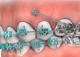 Temporary Anchorage Devices (TADs) | Greater Vancouver Orthodontics