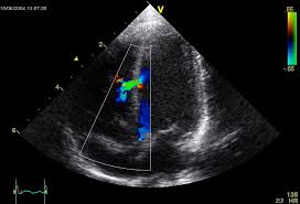 Invasive Coronary Angiogram With Intravascular Ultrasound Images From... |  Download Scientific Diagram