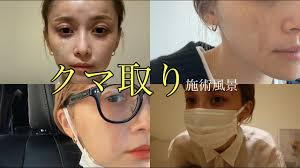 【美容】決心しました、施術しました