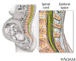Image result for Active Labor Anesthesia