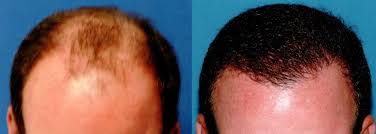 Unlike the rest of the head, hair at the crown grows in a spiraling pattern. Follicular Unit Extraction Fue Hair Transplant Kansas City Des Moines Ia