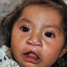 Healing the Children Northern California