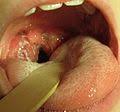 May 07 2015 10:38, started by mrgrj , may 07 2015 08:49. FaringitÄ StreptococicÄ Wikipedia