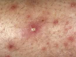 Image result for genital herpes