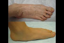 Image result for flegmona pedis)