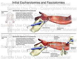 Lateral incisions are made on both sides of chest 2. Escharotomy Vs Fasciotomy Egyptian Plastic Surgery Academy Facebook