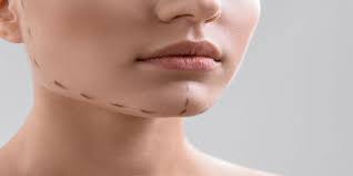 But laser liposuction can get rid of a double chin once and for all. Chin Lipo Rt Aesthetics Newcastle Chin Liposuction