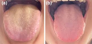 Image result for yellow tongue infection