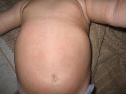 They chiefly cause upper respiratory tract infections (urtis) but may also infect the lower respiratory tract. Baby Rash Pictures Causes Treatments Mommyhood101
