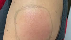 Currently, the trend is clearly linked to moderna mrna. Moderna Vaccine Causing Covid Arm Among Some Patients Kmph