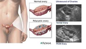 For curly, wavy or coarse hair for dark skin for hormone imbalance or pcos for teenagers for transgender. Hirsutism Hair Removal Pcos Hirsutism Laser Hair Removal Hirsutism Epilight New Skin Clinic