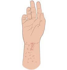 Image result for scabies on humans