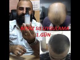 Dermaroller 540 Igneli Titanyum Sac Cikarma Taragi Seffaf Su Sac Cikartan Uygulama 1 Gun Youtube