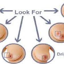 Other symptoms to watch out for. Signs Of Breast Cancer Download Scientific Diagram