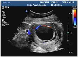 Case 2 Ultrasound Image The Fetal Bladder Was Enlarged With The Download Scientific Diagram
