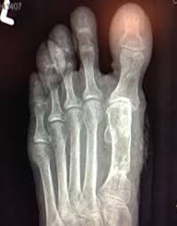 Image result for Hallux Varus