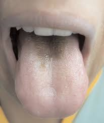 Image result for brown tongue symptoms
