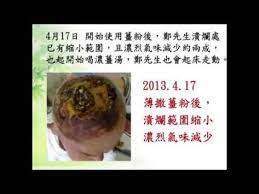 原始點醫學講座河南02 惡性血管肉瘤 薑粉外敷案例 youtube health