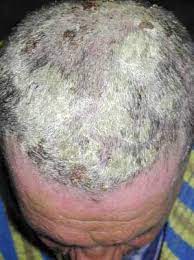Scalp Psoriasis Natural Psoriasis Remedies Dry Skin Treatment Scalp Psoriasis