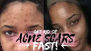 That'll help heal acne scars faster. How To Get Rid Of Acne And Acne Scars Fast Youtube
