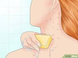 Plusieurs cheveux proviennent du même follicule pileux. 3 Manieres De Soigner La Folliculite Wikihow