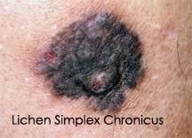 Image result for Lichen Simplex Chronicus