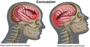 Will smith stars as an american hero who took on an institution to deliver the truth. Physical Therapy Guide To Concussion Choosept Com
