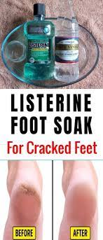Listerine And Vinegar Foot Soak For Cracked Feet Foot Soak Vinegar Listerine Foot Soak