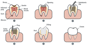 How long does a root canal take? Root Canal Northborough Ma Painless Root Canal Therapy